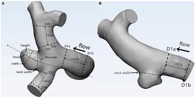 Morphological and Hemodynamic Characteristics Associated With the Rupture of Multiple Intracranial Aneurysms